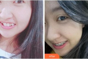 寧波拜博拜爾口腔醫(yī)院沙金賀整形價(jià)格表附金屬托槽矯正案例展示