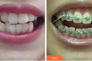 寧波拜博拜爾口腔醫(yī)院潘秋靜整形價(jià)格表附牙齒矯正案例展示