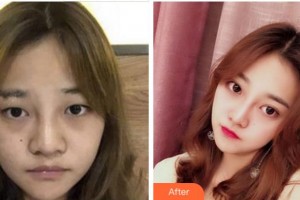 寧波鄞州眼科醫(yī)院陳彥整形價(jià)格表附切開雙眼皮案例展示