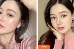 寧波鄞州眼科醫(yī)院朱隆斌整形價(jià)格表附眼部綜合案例展示