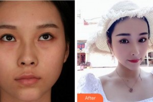 寧波鄞州眼科醫(yī)院孔慶輝整形價(jià)格表附切開(kāi)雙眼皮案例展示