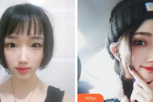 寧波鄞州眼科醫(yī)院鄭志斌整形價(jià)格表附切開(kāi)雙眼皮案例展示