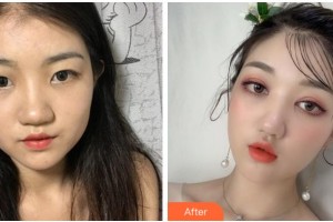 寧波鄞州眼科醫(yī)院周開(kāi)晶整形價(jià)格表附眼部綜合案例展示