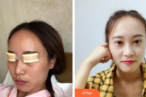 寧波鄞州區(qū)第二醫(yī)院眼科姜黎整形價(jià)格表附切開(kāi)雙眼皮案例展示
