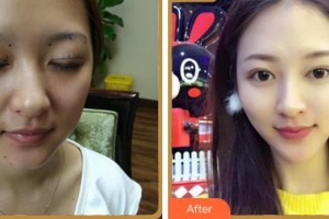 寧波鄞州區(qū)第二醫(yī)院眼科劉惠姣整形價(jià)格表附眼部綜合案例展示