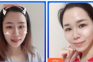 寧波鄞州區(qū)第二醫(yī)院眼科黃玉庚整形價(jià)格表附眼部綜合案例展示