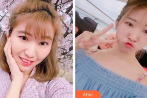 寧波市中醫(yī)院醫(yī)療美容科陳寧剛整形價(jià)格表附切開(kāi)雙眼皮案例展示