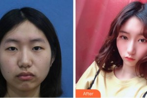 寧波市中醫(yī)院醫(yī)療美容科葉姝整形價(jià)格表附眼部整形案例展示