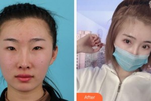 寧波市中醫(yī)院醫(yī)療美容科葉靜靜整形價(jià)格表附眼部綜合案例展示