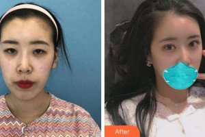 寧波市北侖區(qū)人民醫(yī)院眼科韓偉整形價(jià)格表附眼部綜合案例展示