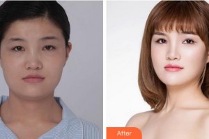 寧波市北侖區(qū)人民醫(yī)院眼科劉嵐整形價(jià)格表附眼部綜合案例展示