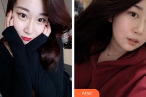 寧波市北侖區(qū)人民醫(yī)院眼科胡蓉蓉整形價(jià)格表附切開(kāi)雙眼皮案例展示