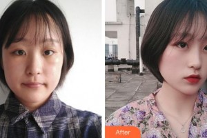 寧波市北侖區(qū)人民醫(yī)院眼科汪曉宇整形價(jià)格表附激光去眼袋案例展示