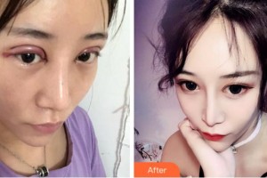 寧波市北侖區(qū)人民醫(yī)院眼科陳艷紅整形價(jià)格表附切開(kāi)雙眼皮案例展示