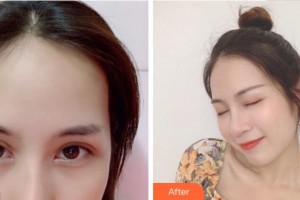 寧波市北侖區(qū)人民醫(yī)院眼科楊崇清整形價(jià)格表附眼部綜合案例展示