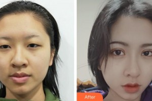 寧波市北侖區(qū)人民醫(yī)院眼科盛艷整形價(jià)格表附眼部綜合案例展示