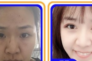 寧波市北侖區(qū)人民醫(yī)院眼科董楓整形價(jià)格表附眼部綜合案例展示