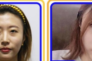 寧波市北侖區(qū)人民醫(yī)院眼科盧紅整形價(jià)格表附眼部綜合案例展示