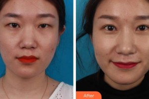 寧波市北侖區(qū)人民醫(yī)院眼科孫雯整形價(jià)格表附切開(kāi)雙眼皮案例展示