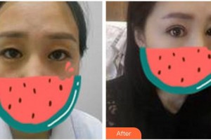 寧波愛(ài)爾光明眼科醫(yī)院李小萍整形價(jià)格表附切開(kāi)雙眼皮案例展示