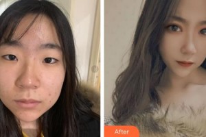 寧波愛(ài)爾光明眼科醫(yī)院高小明整形價(jià)格表附埋線雙眼皮案例展示