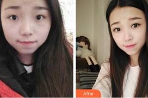 寧波愛(ài)爾光明眼科醫(yī)院曾慶森整形價(jià)格表附切開(kāi)雙眼皮案例展示