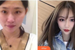 寧波牙博士口腔醫(yī)院王道軍整形價(jià)格表附眼部綜合案例展示