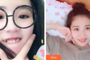 寧波牙博士口腔醫(yī)院劉清陽(yáng)整形價(jià)格表附牙齒隱形矯正案例展示