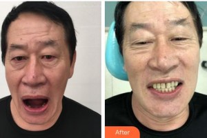 寧波牙博士口腔醫(yī)院武文東整形價(jià)格表附種植牙案例展示