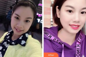 寧波現(xiàn)代口腔醫(yī)院張?zhí)烨蛘蝺r(jià)格表附金屬托槽矯正案例展示