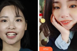 寧波現(xiàn)代口腔醫(yī)院賀露娜整形價(jià)格表附金屬托槽矯正案例展示