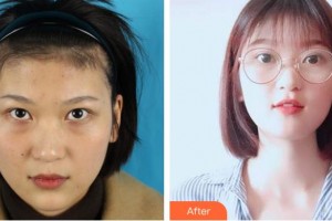 寧波市眼科醫(yī)院袁建樹整形價(jià)格表附內(nèi)切祛眼袋案例展示