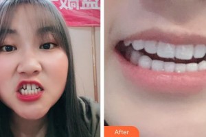 寧波千口百惠口腔門診部張玉濤整形價(jià)格表附瓷貼面案例展示