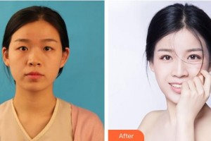 寧波明州醫(yī)院眼科周谷平整形價(jià)格表附眼部綜合案例展示