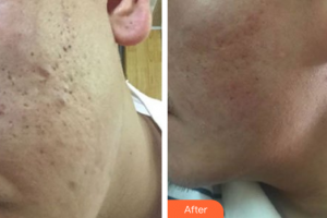 深圳麗港麗格醫(yī)療美容門診部舒暢整形價格表附微針淡化痘印案例展示