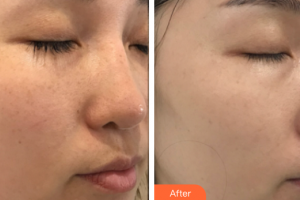 深圳韓佳醫(yī)療美容門診部王煥英整形價格表附多方面部較準祛斑案例展示