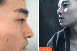 深圳韓佳醫(yī)療美容門診部文中華整形價格表附硅膠下巴案例展示