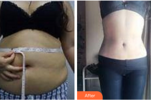 深圳博愛曙光醫(yī)院苗春來整形價格表附腰腹吸脂案例展示