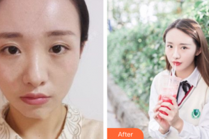 深圳民生婦科醫(yī)院整形美容中心張偉彬整形價格表附鼻部手術(shù)案例展示