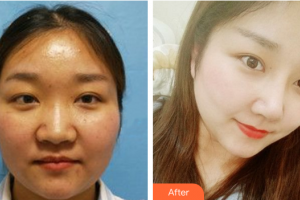 深圳博愛醫(yī)院整形美容中心許國明整形價格表附鼻部手術(shù)案例展示