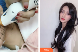 深圳鵬程醫(yī)院整形美容中心李莉婷整形價格表附熱瑪吉案例展示