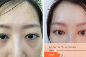 深圳瑞芙臣醫(yī)療美容門診部劉丹虹整形價格表附內(nèi)路去眼袋案例展示