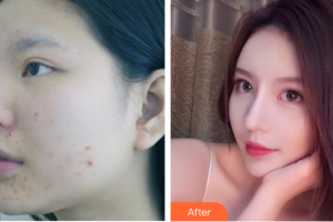 深圳鵬程醫(yī)院整形美容中心解慧慧住院醫(yī)師整形價格表附紅藍光祛痘案例展示