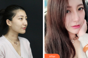 深圳鵬程醫(yī)院整形美容中心王善祥整形價格表附美白嫩膚案例展示