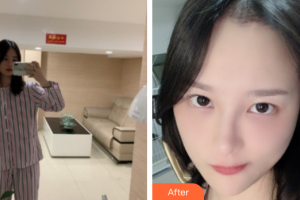 深圳鵬程醫(yī)院整形美容中心林彩萍整形價格表附種植發(fā)際線案例展示