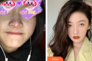 深圳百合醫(yī)療美容門診部姚堯整形價格表附自體肋骨隆鼻案例展示