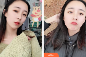 深圳百合醫(yī)療美容門診部付淑蘭整形價格表附美白嫩膚案例展示