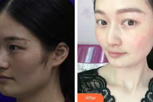 深圳百合醫(yī)療美容門診部王定芳整形價格表附祛斑祛痣案例展示