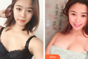 深圳韓美爾醫(yī)療美容門診部楊維琦整形價格表附自體脂肪隆胸案例展示