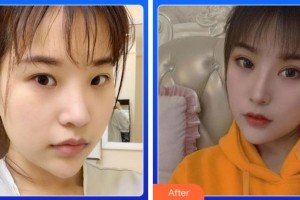 寧波藝星整形美容醫(yī)院朱繼鋒整形價(jià)格表附切開雙眼皮案例展示